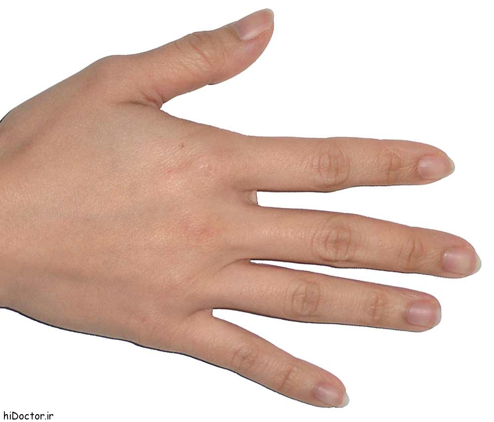 علت و درمان پوسته پوسته شدن دست ها
