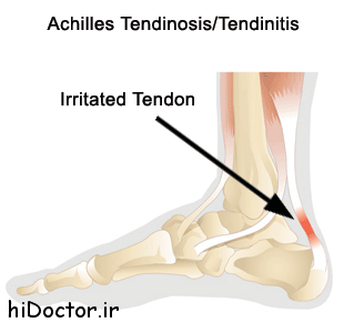 tendons