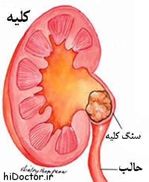 kidneyStone-1m