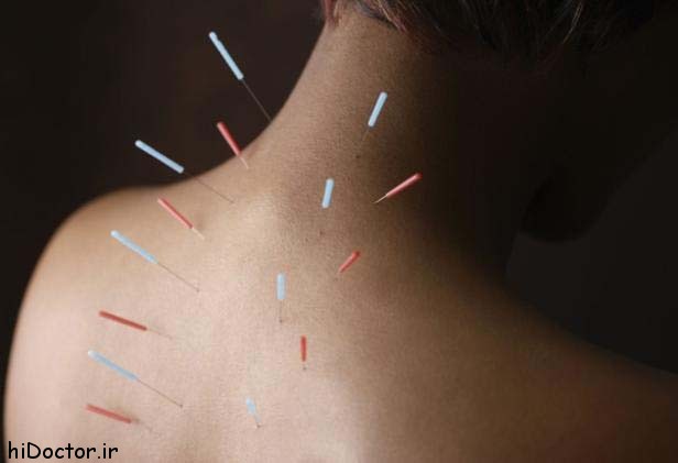acupuncture-back-copy