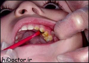 سوالات شایع در مورد درمان های دندانپزشکی کودکان 3