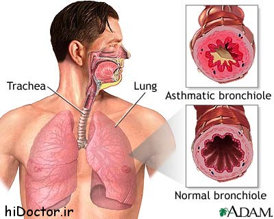 آسم چه بیماری است؟ انواع آسم و علائم آن چیست؟ 