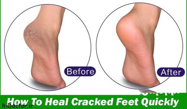 600x350xHow-To-Heal-Cracked-Feet-Quickly.jpg.pagespeed.ic.jY6sWCQOW1