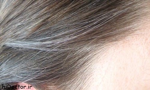 causes-of-premature-graying-of-hair