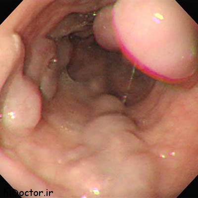 esophageal_varices