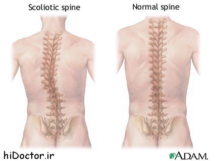 scoliosis_of_the_spine