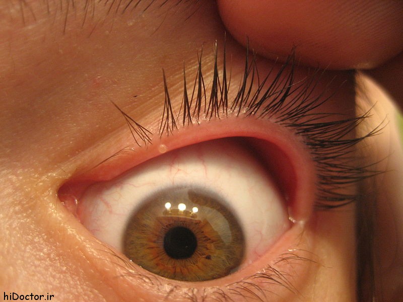 درمان جوش داخل پلک چشم