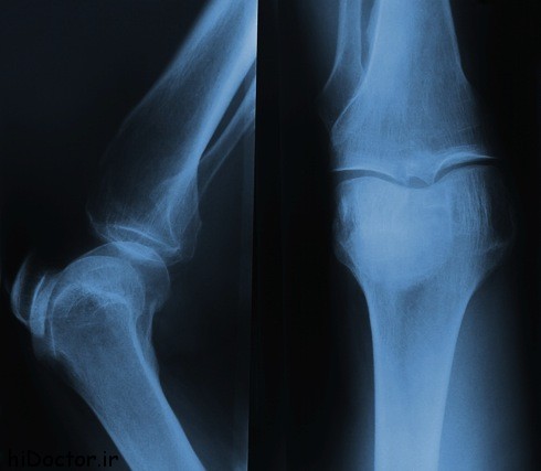 X-ray of the knee.