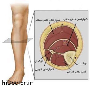 همه چیز را درباره سندرم کمپارتمان بدانیم 1