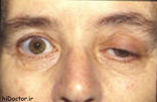 Myasthenia