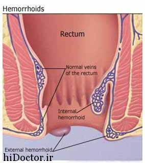 This-picture-is-showing-how-a-hemorrhoid-look-like-7