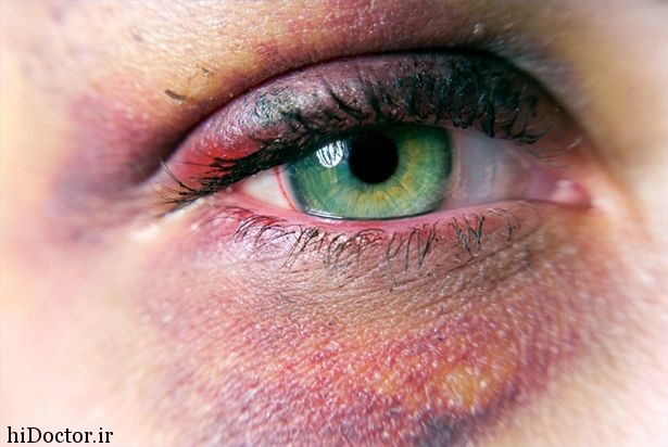 article-new-thumbnail-ehow-images-a02-2l-f3-treat-black-eye-bruise-800x800
