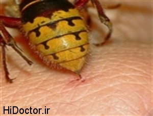image11869 1 300x227  مراقبت‌ های پزشکی پس از نیش زنبور