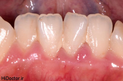incisal-teeth3-510x336