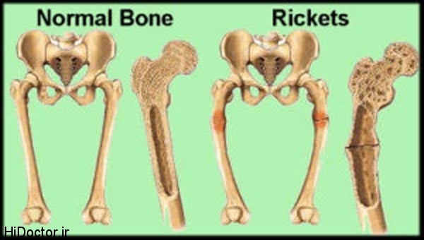 ricketsbone big