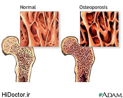 Osteoporosis-bone-density-graphic