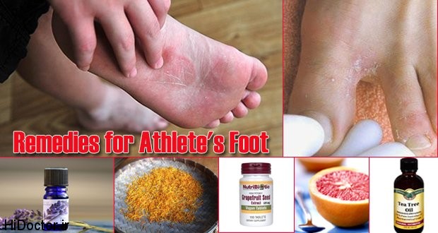 Remedies for Athletes Foot 15 درمان خانگی برای قارچ پای ورزشکاران