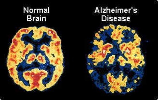 alzheimers-large