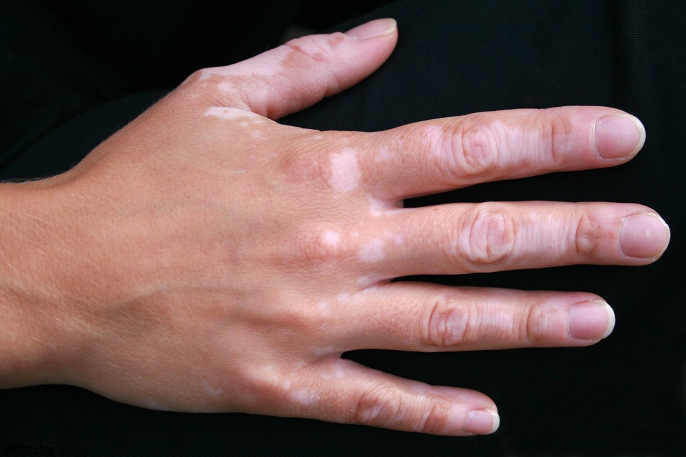 Vitiligo-of-Hands