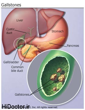understanding_gallstones_basics_gallstones