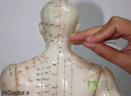 Acupuncture photos aks tebe zoozani 16 عکس های طب سوزنی