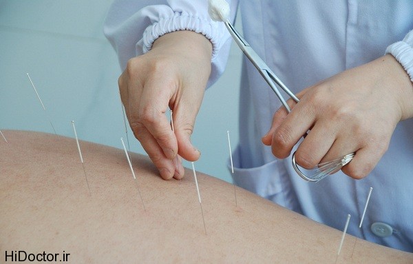 Acupuncture photos aks tebe zoozani 5 عکس های طب سوزنی