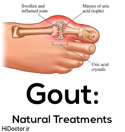 gout-natural-treatments