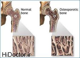عوامل تخریب استقامت استخوان در اقایان 1