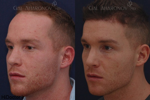male_forehead_reduction_hairline_lowering_men_02