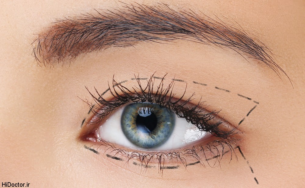 upper eyelid surgery markings