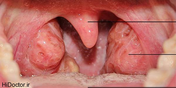 800px-Throat_with_Tonsils_0011J