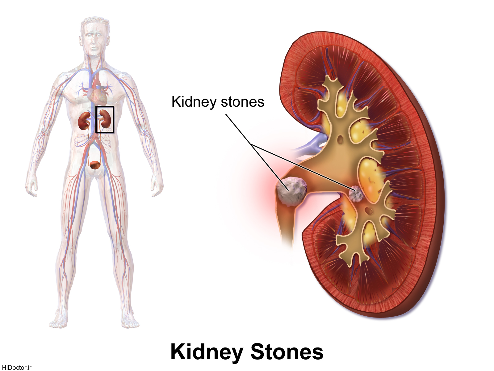 Blausen_0595_KidneyStones