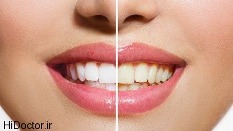 Effective-Home-Remedies-To-Get-White-Teeth-454x255