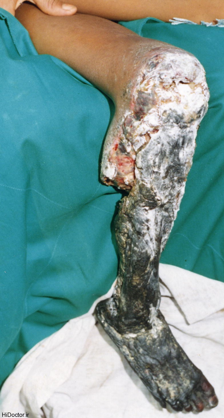 Tissue necrosis following bite from Bothrops asper PLoS Medicine از بین رفتن پای این کودک با سم مار