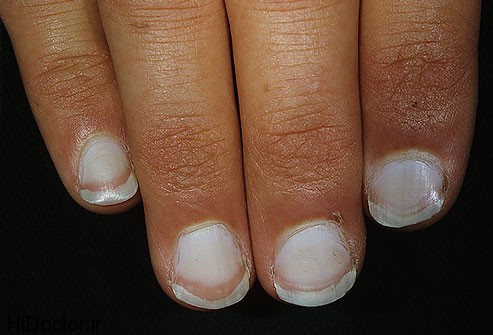 dermnet_photo_of_white_nails
