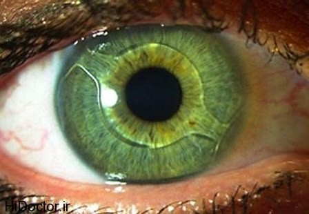 intra-ocular-contact-lenses.jpg