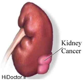 kidney_cancer