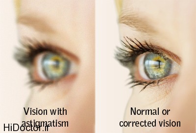 lco-astigmatism-news-blog