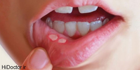 آیا آفت دهان به علت کمبود ویتامین است 1