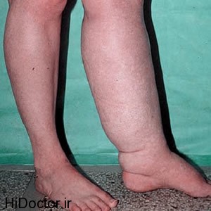 swelling in the legs طرز صحیح نشستن افرادی که ورم پا دارند