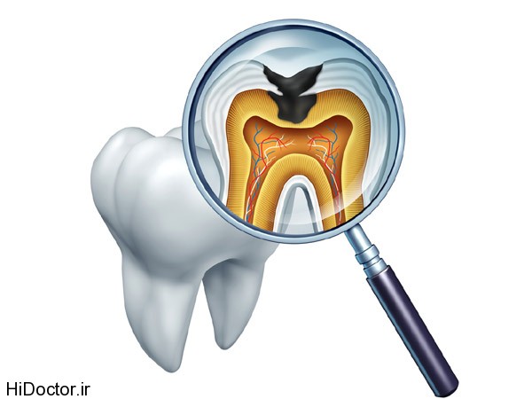 tooth decay انتظارات ما از خمیر دندان چیست؟