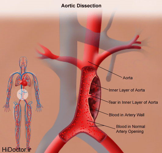 Aortic-dissection