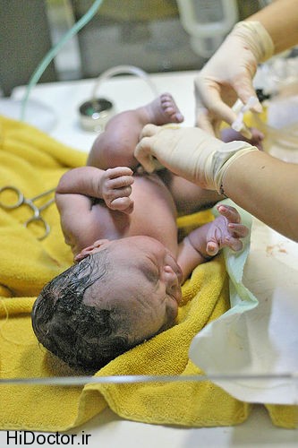 Umbilical newborn چرا پزشکان پیشنهاد زایمان طبیعی می دهند!