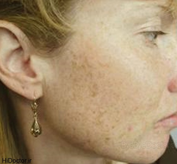 brown-spots-on-face-pictures
