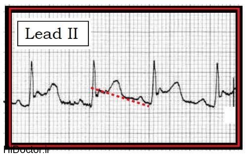 heart در نوار قلب نشانه های بيمارى پريكارديت