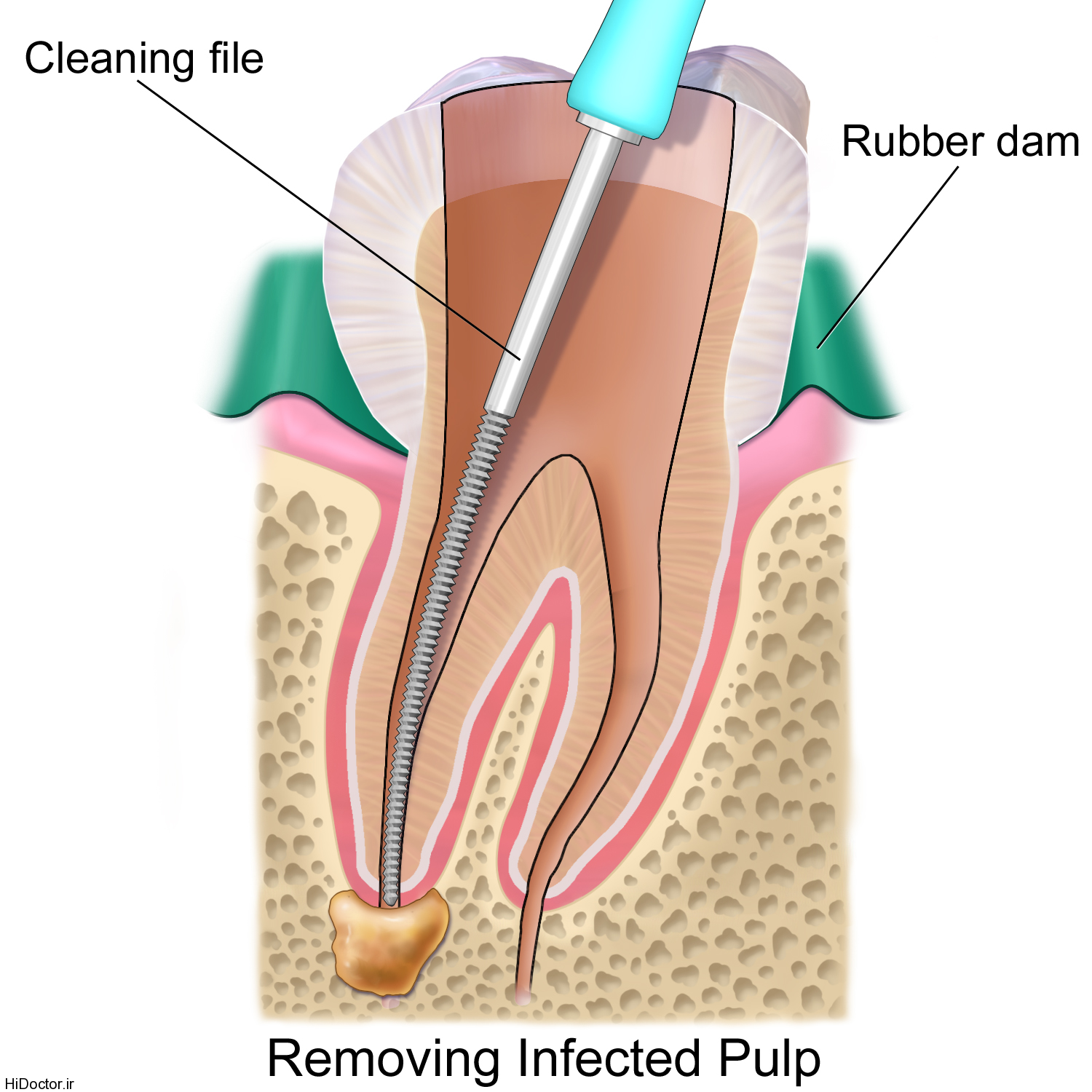 Blausen 0774 RootCanal اطلاعاتی راجع به عصب کشی دندان