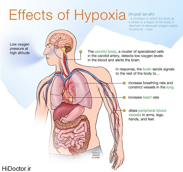 Hypoxia photo تعریف هایپراکسی و هیپوکسی