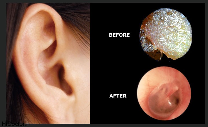 earwaxgone-belfast-earwax