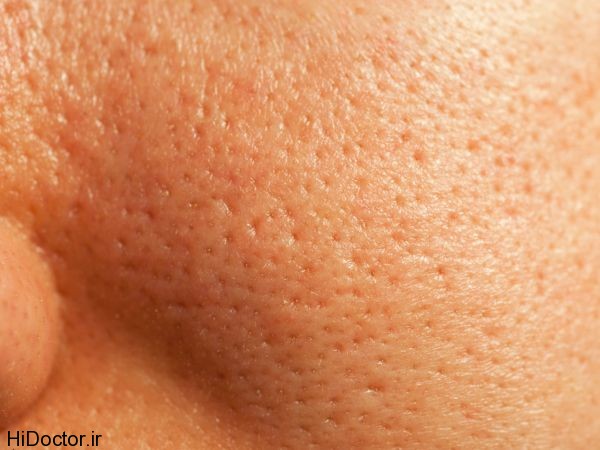 pores 600x450 چرا منافذ پوست بزرگتر می شود و درمانهای طبیعی آن