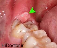 کشیدن دندان عقل عوارض دندان عقل دندان‌های عقل نیمه نهفته دندان‌های عقل نهفته   